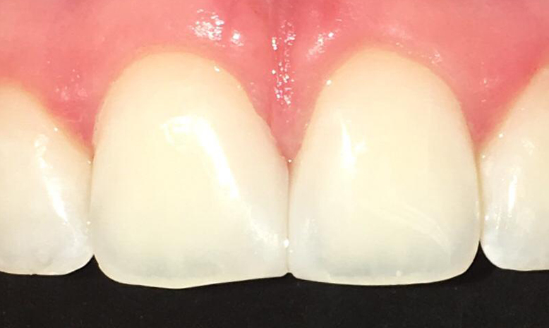 dental bonding showing gap removal in cookstown