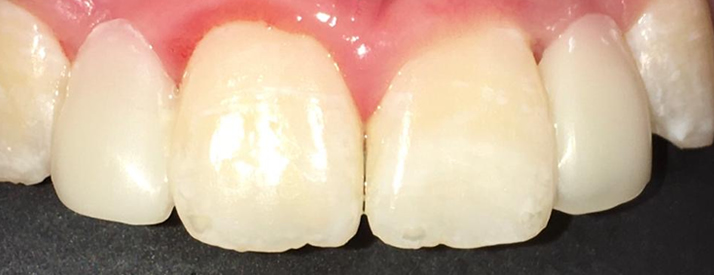 dental bonding cookstown