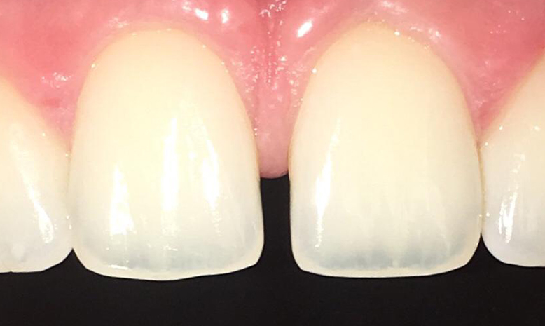 dental bonding at loy dental northern ireland