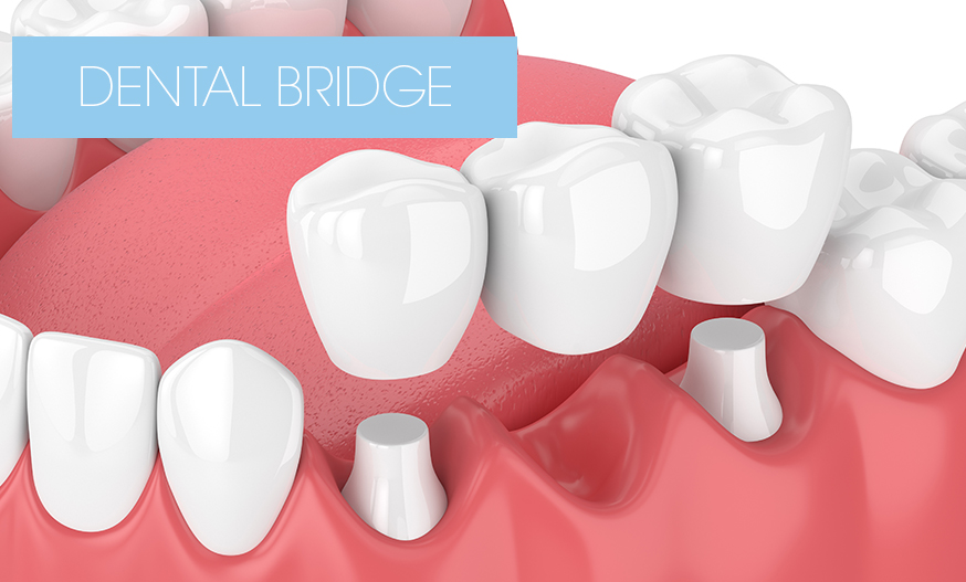 graphic showing how your tooth bridge will work
