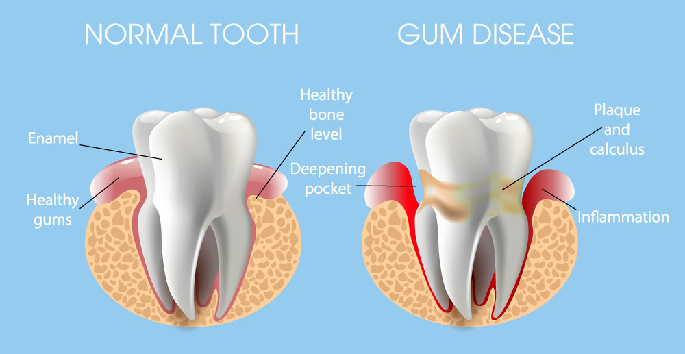 differences in healthy and diseased teeth with gum disease