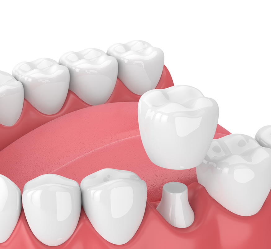 graphic of dental crown
