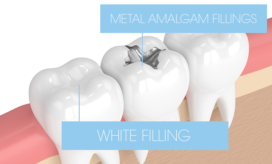 graphic showing different appearance  of white and metal fillings